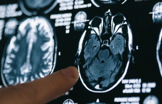 Alzheimer hastaları için gerçek bir tedavi sunan...